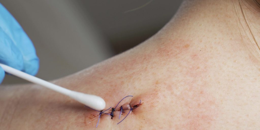A doctor treats a wound on a woman's shoulder. Consequences of breast surgery, laparoscopy.